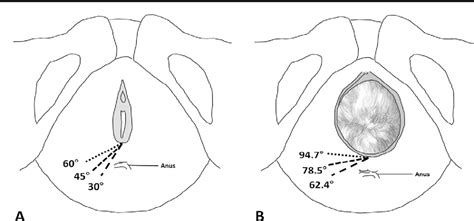 The Optimal Angle Of The Mediolateral Episiotomy At Crowning Of The