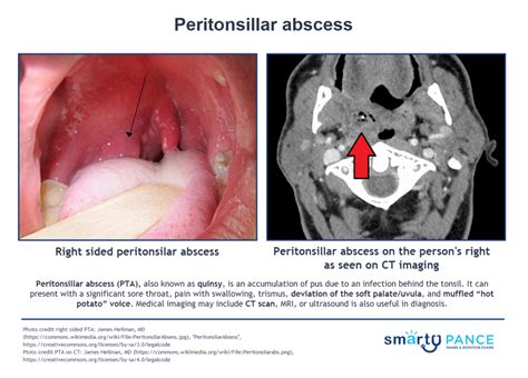 Peritonsillar Abscess Diagram Quizlet