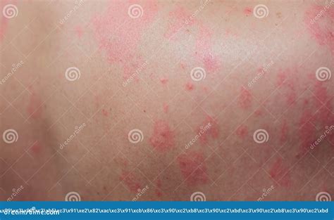 人皮炎皮炎皮疹过敏性皮疹与健康问题的近视 库存照片 图片 包括有 男人 腋窝 过敏 皮炎 人类学 154810266