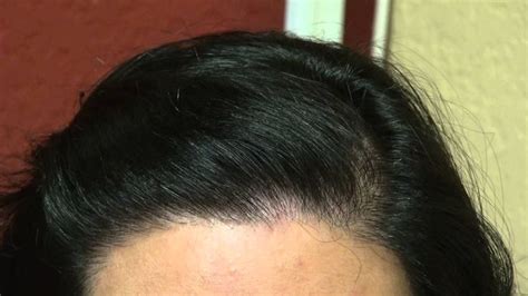 Excellent Bay Area Women Receding Bald Hairline Restoration Surgery