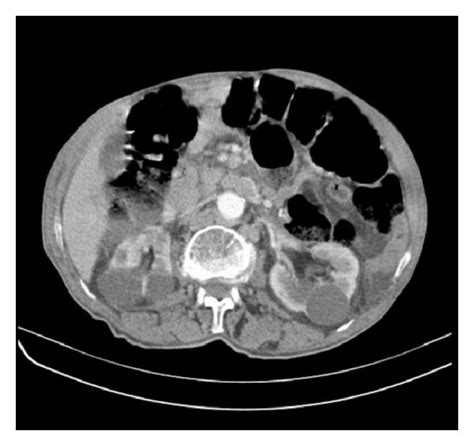Abdominal Ct Demonstrating Multiple Enlarged Lymph Nodes In The