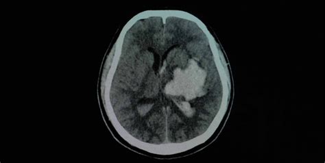 Cerebral Hemorrhage Causes And Methods Of Treatment Enlife News