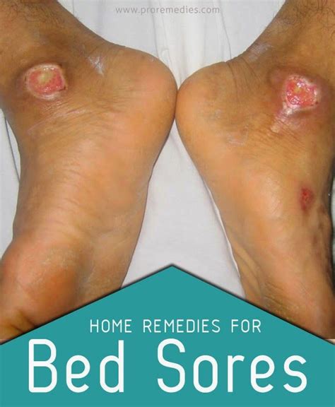 Home Remedies For Bed Sores Bed Sores Health Heal Home Remedies