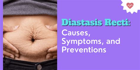 Diastasis Recti Causes Symptoms And Preventions 2022
