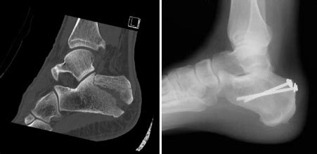 Calcaneus Heel Bone Fractures OrthoInfo AAOS