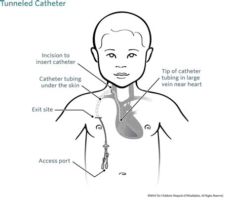 Tunneled Catheter Childrens Hospital Of Philadelphia