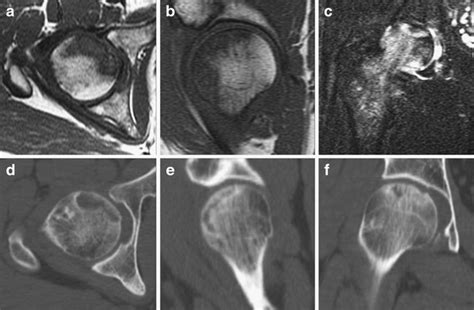 Diagnostic Performance Of MR Imaging In The Assessment Of Subchondral