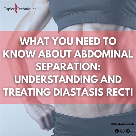 What You Need To Know About Abdominal Separation Understanding And