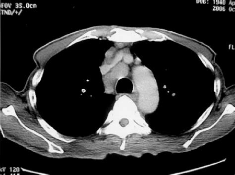 A Chest Ct Scan Revealed A Marked Enlargement Of The Mediastinal Lymph