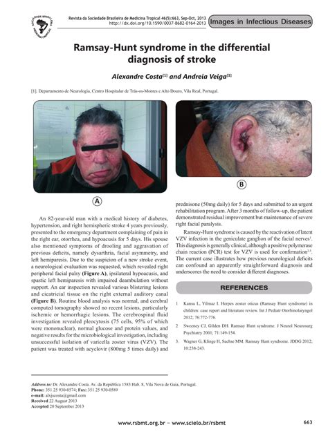 Pdf Ramsay Hunt Syndrome In The Differential Diagnosis Of Stroke