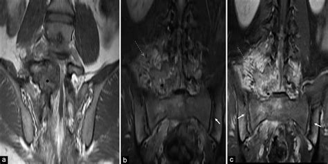 Toxic Flare Phenomenon In Osteoblastoma A Case Report With Literature