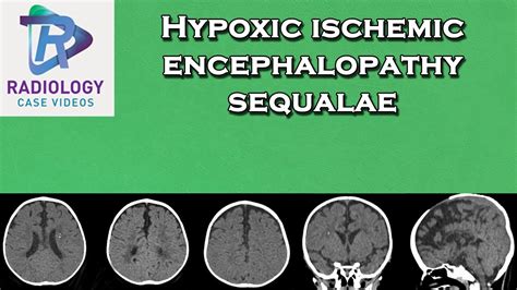 Hypoxic Ischemic Encephalopathy Sequalae Youtube