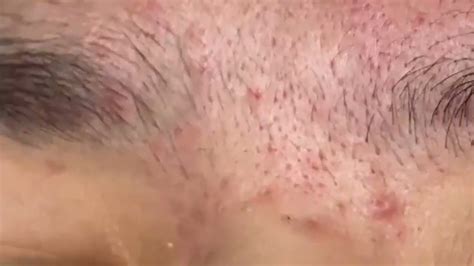 Blackheads And Milia Big Cystic Acne Blackheads Extraction Whiteheads