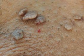 Verrugas genitales enfermedades del ano fotos. Elimina definitivamente las verrugas. Clínica Estética en ...