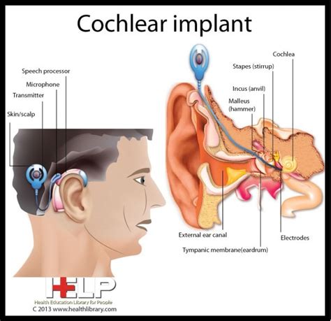cochlear implant diagram