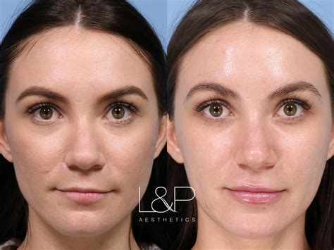 Microneedling Before And After Photo Gallery Palo Alto San Jose