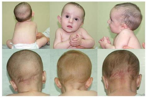 Torticollis And Plagiocephaly Pediatric Pt — Brill Physical Therapy