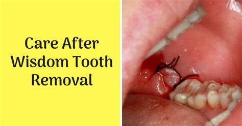 Care After Wisdom Teeth Removal Expert Dental Care