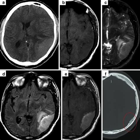 Axial Ct Of Acute Right Subdural Haematoma With Midline Shift