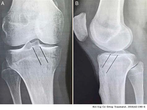 Tibial Tunnel Widening Associated With Anterior Cruciate Ligament