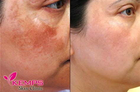 What Is Skin Pigmentation On The Face And Its Treatment Kemps Skin