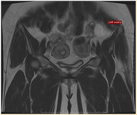 Bicornuate Uterus Mri Sumer S Radiology Blog