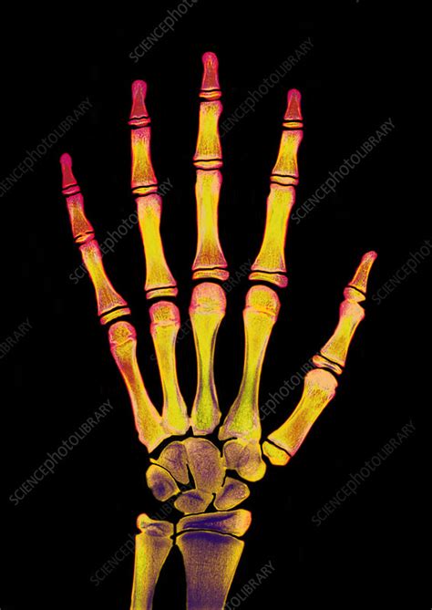 Childs Hand X Ray Stock Image P1160654 Science Photo Library