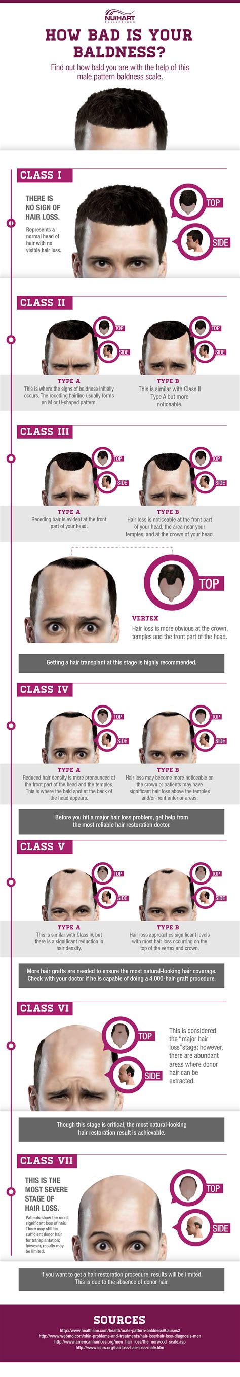 The different stages of hair loss can be categorized into the either the norwood or savin scale stage 3 is where we first start to see the signs of clinically significant hair loss and balding. Stages of Male Pattern Baldness Infographic