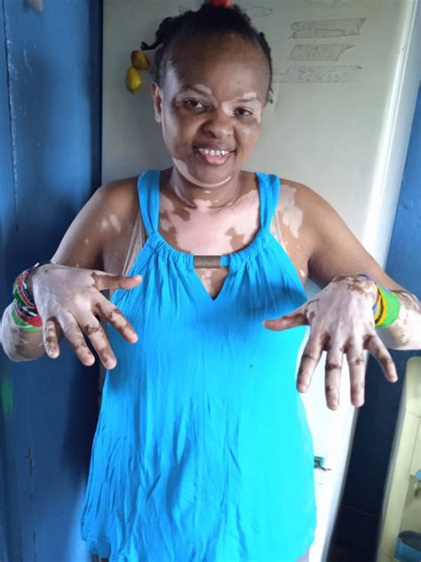 Machacharis Mama Stella Gets Help To Manage Skin Condition