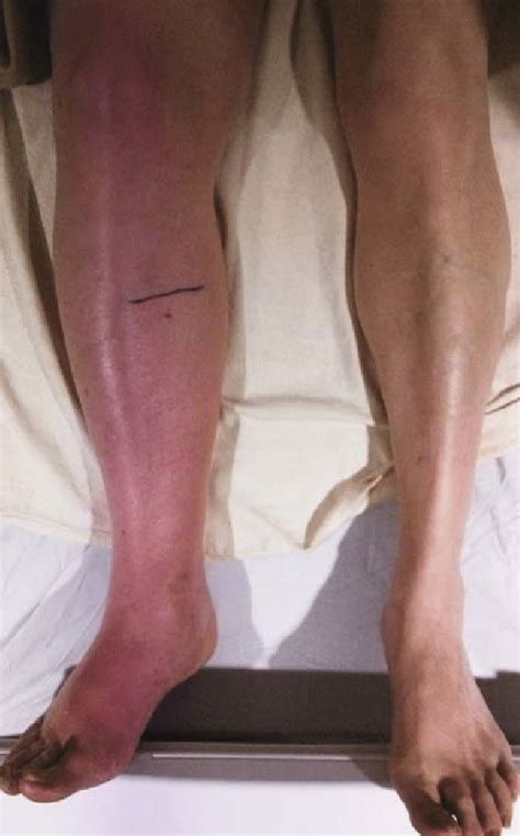 The Patient Had Painful Swelling And Bluish Red Discoloration Of The