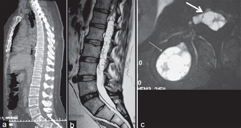 Preoperative Imaging A Sagittal Ct Scan Of The Spine Did Not Show My XXX Hot Girl