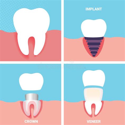 Tandenproblemen Zieke Tand In Gom De Stomatologie Vector Illustratie