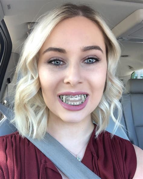 Braces Girlswithbraces Metalbraces Elastics Grillz Orthodontie Appareil Dentaire
