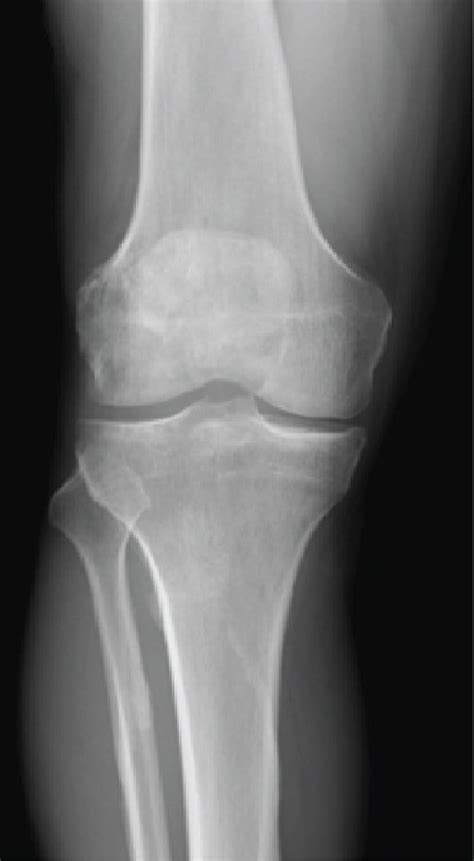 A X Ray Of The Involved Distal Femur Shows A Mixed Lucent Sclerotic