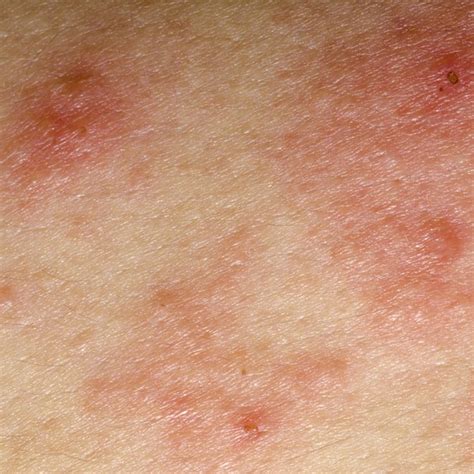 Diseases That Cause Eczema Livestrongcom