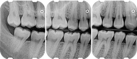 31 Radiographic Aids In The Diagnosis Of Periodontal Disease Pocket