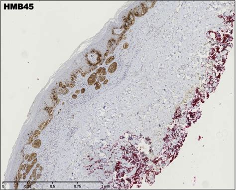 Histoquarterly Superficial Spreading Malignant Melanoma Histology Blog