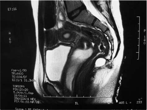 Rectal Atresia And Stenosis Unique Anorectal Malformations Journal