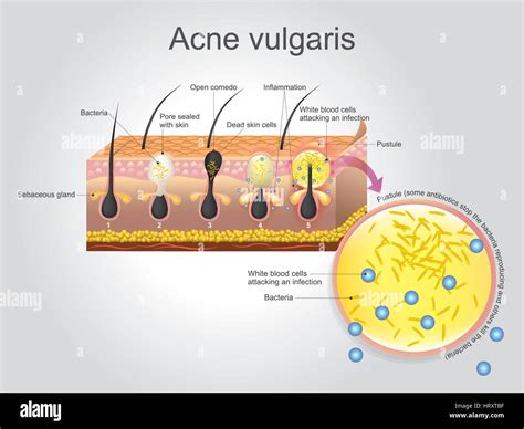 Acne Vulgaris Is A Long Term Skin Disease That Occurs When Hair