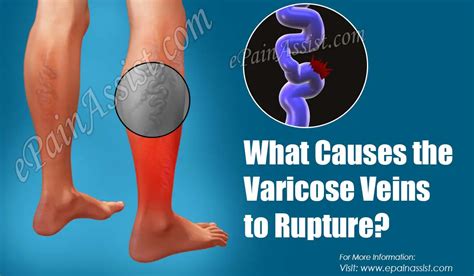 What Causes The Varicose Veins To Rupture And How Is It Treated