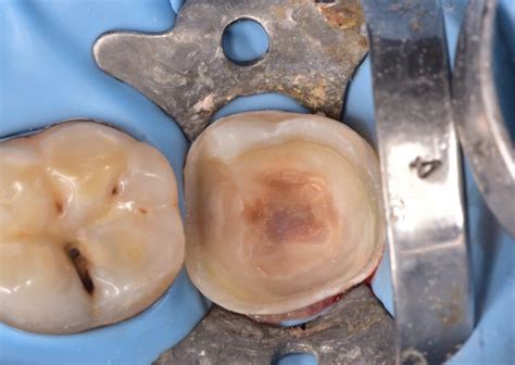 Saving Severely Decayed Lower Second Molar Myzerodonto