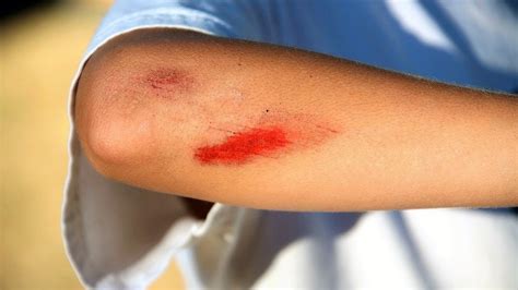 Wound Care 5 Natural Ways To Heal Cuts And Scrapes Youtube