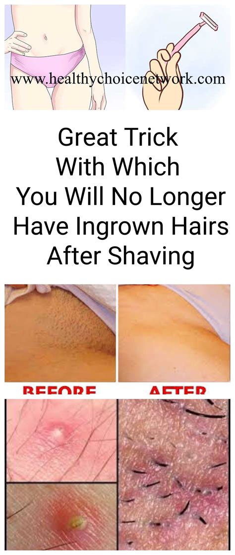 Trick Ingrown Hair Razor Shaving Beauty Problem Shaving
