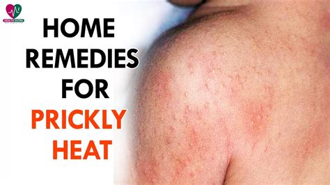 Simple Home Remedies For Prickly Heat Health Sutra Youtube