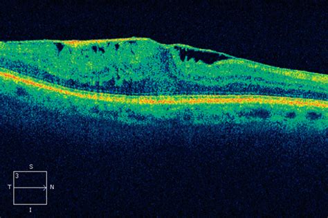 Eyedolatry Diagnose My Retinal Photo Epiretinal Membrane Lexington