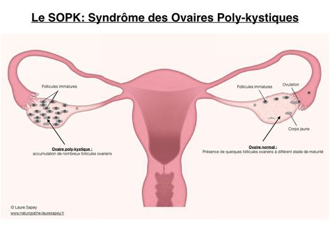 Syndrome Des Ovaires Poly Kystiques Sopk Qu Est Ce Que C Est