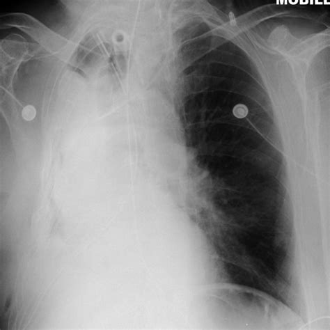 Chest X Ray Obtained On Postoperative Day A Total Atelectasis I E Download Scientific