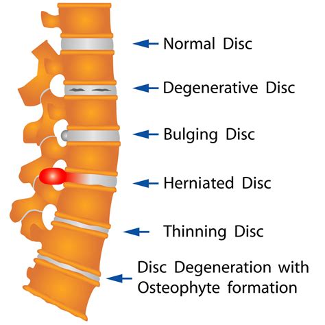 Disc Disorder And Spine Treatment Nj North Jersey Spine Group