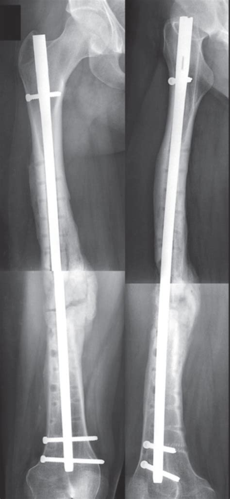 The Patient Presented An Atraumatic Fracture Of The Neoformed Bone A