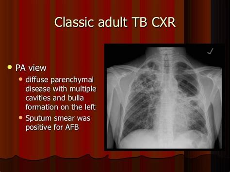 Tuberculosis Diagnosis By Dr Najeeb